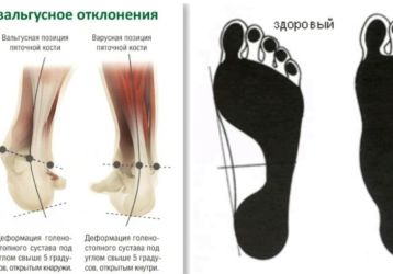 Варусная деформация стопы и ног у детей: причины, профилактика, лечение