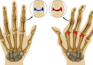 Лечение воспаления суставов пальцев рук: причины, статистика, медикаменты и процедуры