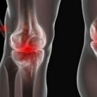 Причины, симптомы и лечение реактивного артрита