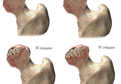 Артроз тазобедренного сустава 2 степени — симптомы и лечение заболевания