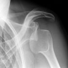 Вывих плеча: причины травм, симптомы и варианты лечения