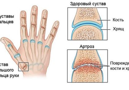 Остеоартроз кистей рук: симптоматика и лечение