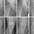 Коксартроз 1 степени, лечение тазобедренного сустава