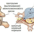 Причины протрузий дисков шейного отдела позвоночника: стадии, симптомы, лечение и профилактика