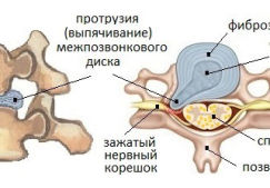 Причины протрузий дисков шейного отдела позвоночника: стадии, симптомы, лечение и профилактика