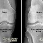 Лечение остеоартроза коленного сустава 2 степени, причины и симптомы заболевания