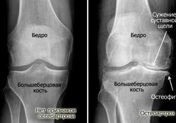 Лечение остеоартроза коленного сустава 2 степени, причины и симптомы заболевания