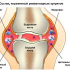 Лекарства последнего поколения для лечения ревматоидного артрита