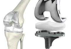 Эндопротезирование коленного сустава, отзывы реальных пациентов