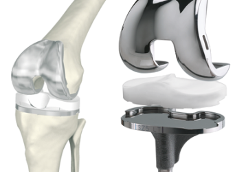Эндопротезирование коленного сустава, отзывы реальных пациентов