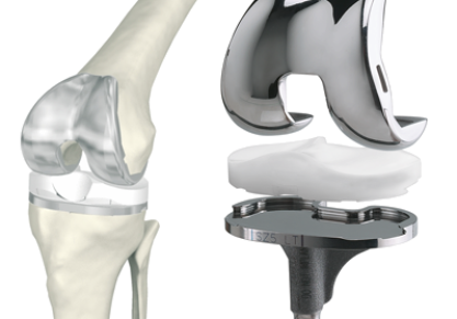 Эндопротезирование коленного сустава, отзывы реальных пациентов
