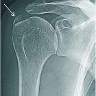 Причины, симптомы и лечение плечелопаточного периартрита