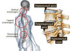 Массаж при остеохондрозе: польза и основные техники