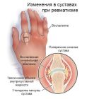 Ревматизм суставов — симптомы и лечение, чем опасна эта болезнь