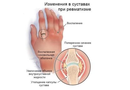 Ревматизм суставов — симптомы и лечение, чем опасна эта болезнь