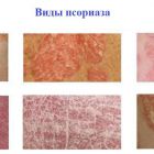 Существует ли псориатический артроз?