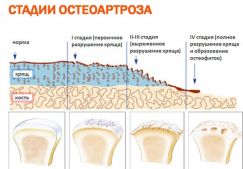 Генерализованный остеоартроз: лечение первичного и вторичного типа