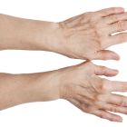 Причины появления шишек на пальцах рук, методы лечения