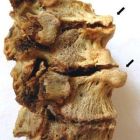 Как лечить остеохондроз в домашних условиях? Медикаменты, ЛФК, диета, массаж