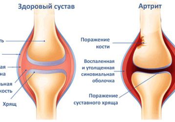 Лечение народными методами артрита коленного сустава