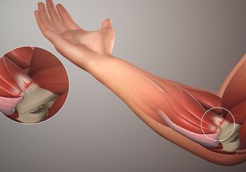 Защемление нерва в локтевом суставе: как диагностировать, чем лечить
