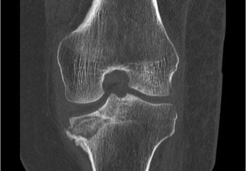Асептический некроз коленного сустава: классификация, диагностика, лечение