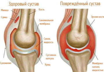 Детский артрит коленного сустава: симптомы и лечение