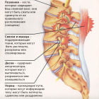 Острый хондроз: симптомы и лечение. Что делать при ухудшении состояния