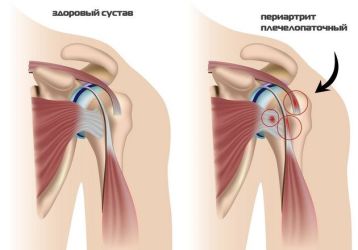 Медикаментозное лечение плечелопаточного периартрита:  перечень основных препаратов