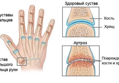 Артроз пальцев рук: симптомы и лечение, причины, полное описание заболевания