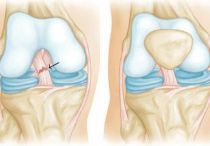 Разрыв передней крестообразной связки колена: причины, симптомы и методы лечения