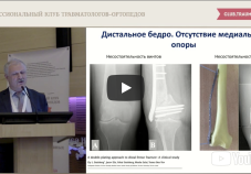 Видео презентация: переломы дистального отдела бедренной кости. И.Г. Беленький (С-Петербург)