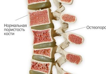 Симптомы эффективное лечение остеопороза позвоночника, диагностика заболевания