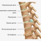 Может ли грыжа позвоночника уменьшиться или пройти сама и рассосаться