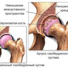 История основания эндопротезирования тазобедренного и коленного суставов