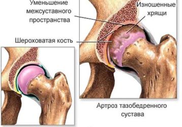 История основания эндопротезирования тазобедренного и коленного суставов