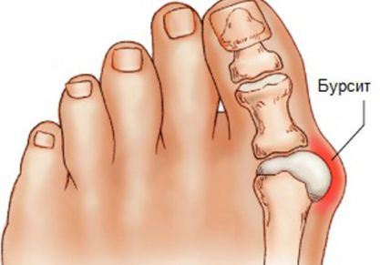 Лечение бурсита большого пальца стопы медикаментами, мазями и хирургически
