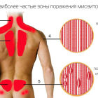 Что такое миозит мышц: причины, основные признаки и методы лечения