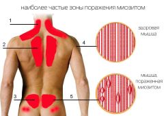 Что такое миозит мышц: причины, основные признаки и методы лечения