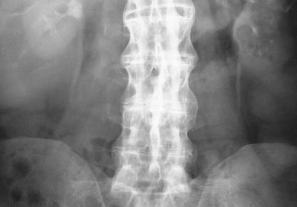 Болезнь Бехтерева у женщин: симптомы, лечение, полное описание недуга