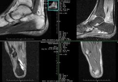 Визуализирующие возможности МРТ голеностопного сустава и стопы