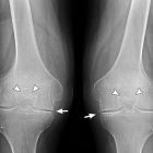 Мази при артрозе коленного сустава, тазобедренного, локтевого и других, виды и показания к применению
