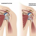 Лечение периартрита плечевого сустава в домашних условиях народными средствами