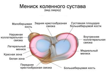 Менископатия коленного сустава: симптомы и лечение