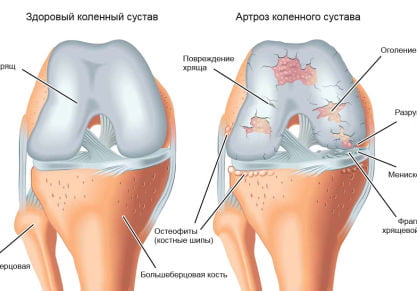 Комплекс упражнений для пожилых людей при артрозе коленных суставов