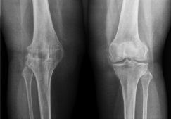Анкилоз суставов: тазобедренный, коленный, локтевой. Что это такое и способы лечения
