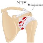 Артрит плечевого сустава (плеча): причины, симптомы, лечение