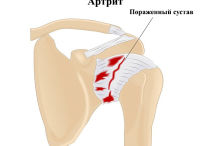 Артрит плечевого сустава (плеча): причины, симптомы, лечение