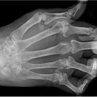 Подагра: признаки и лечение, симптомы, полное описание заболевания