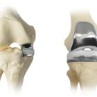 Операция по замене коленного сустава: описание процесса